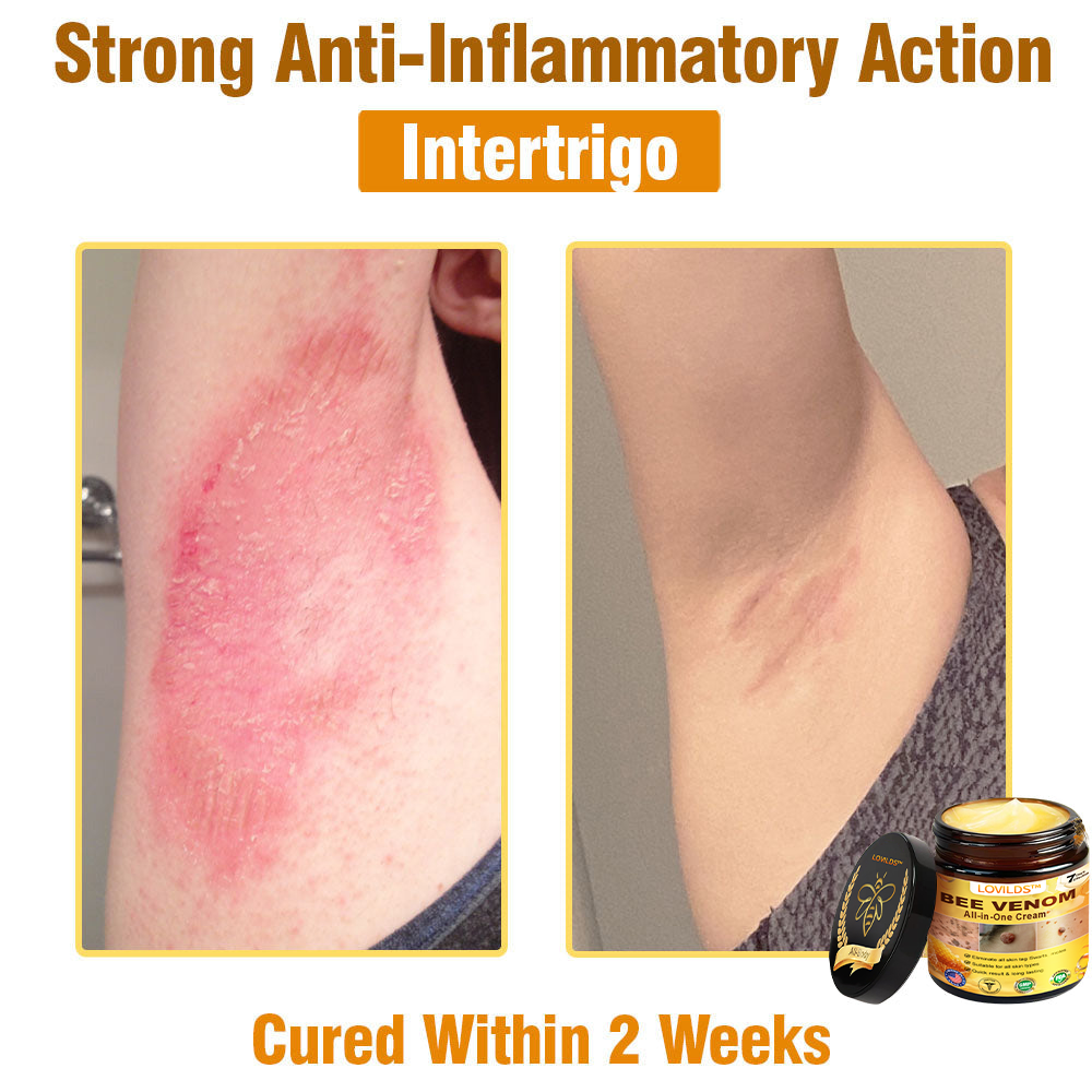 𝐋𝐎𝐕𝐈𝐋𝐃𝐒™ 𝐁𝐞𝐞 𝐕𝐞𝐧𝐨𝐦 𝐀𝐥𝐥-𝐢𝐧-𝐎𝐧𝐞 𝐂𝐫𝐞𝐚𝐦–🌸 🌸Anti-aging,Hydrating, Skin Repair, Even Tone, Acne and Dark Spot Treatment, Wart and Mole Removal, Psoriasis Relief