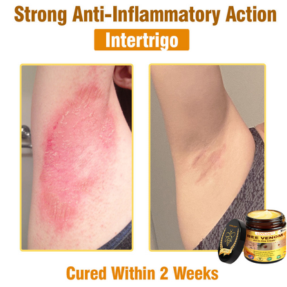 𝐋𝐎𝐕𝐈𝐋𝐃𝐒™ 𝐁𝐞𝐞 𝐕𝐞𝐧𝐨𝐦 𝐀𝐥𝐥-𝐢𝐧-𝐎𝐧𝐞 𝐂𝐫𝐞𝐚𝐦–🌸 🌸Anti-aging,Hydrating, Skin Repair, Even Tone, Acne and Dark Spot Treatment, Wart and Mole Removal, Psoriasis Relief