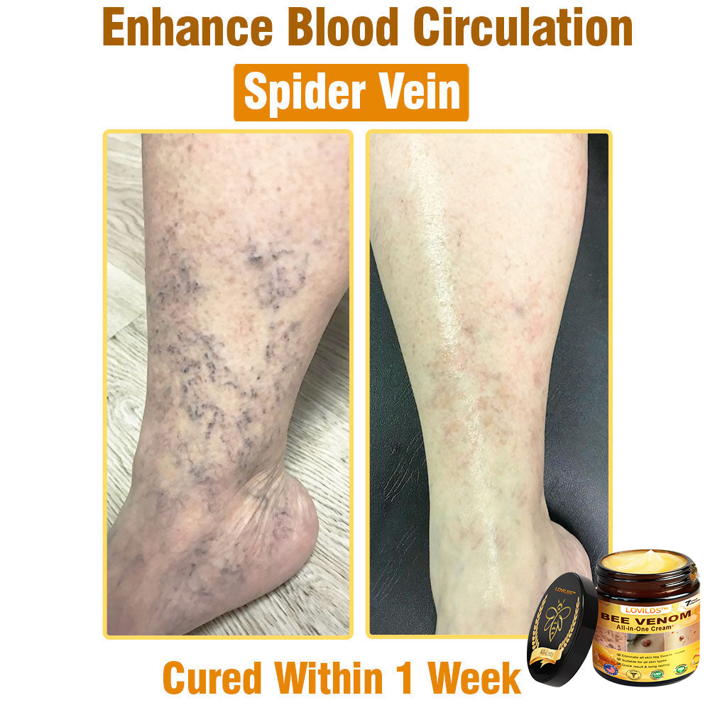 𝐋𝐎𝐕𝐈𝐋𝐃𝐒™ 𝐁𝐞𝐞 𝐕𝐞𝐧𝐨𝐦 𝐀𝐥𝐥-𝐢𝐧-𝐎𝐧𝐞 𝐂𝐫𝐞𝐚𝐦–🌸 🌸Anti-aging,Hydrating, Skin Repair, Even Tone, Acne and Dark Spot Treatment, Wart and Mole Removal, Psoriasis Relief