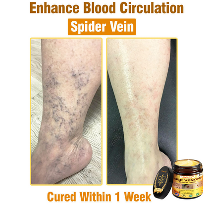 𝐋𝐎𝐕𝐈𝐋𝐃𝐒™ 𝐁𝐞𝐞 𝐕𝐞𝐧𝐨𝐦 𝐀𝐥𝐥-𝐢𝐧-𝐎𝐧𝐞 𝐂𝐫𝐞𝐚𝐦–🌸 🌸Anti-aging,Hydrating, Skin Repair, Even Tone, Acne and Dark Spot Treatment, Wart and Mole Removal, Psoriasis Relief