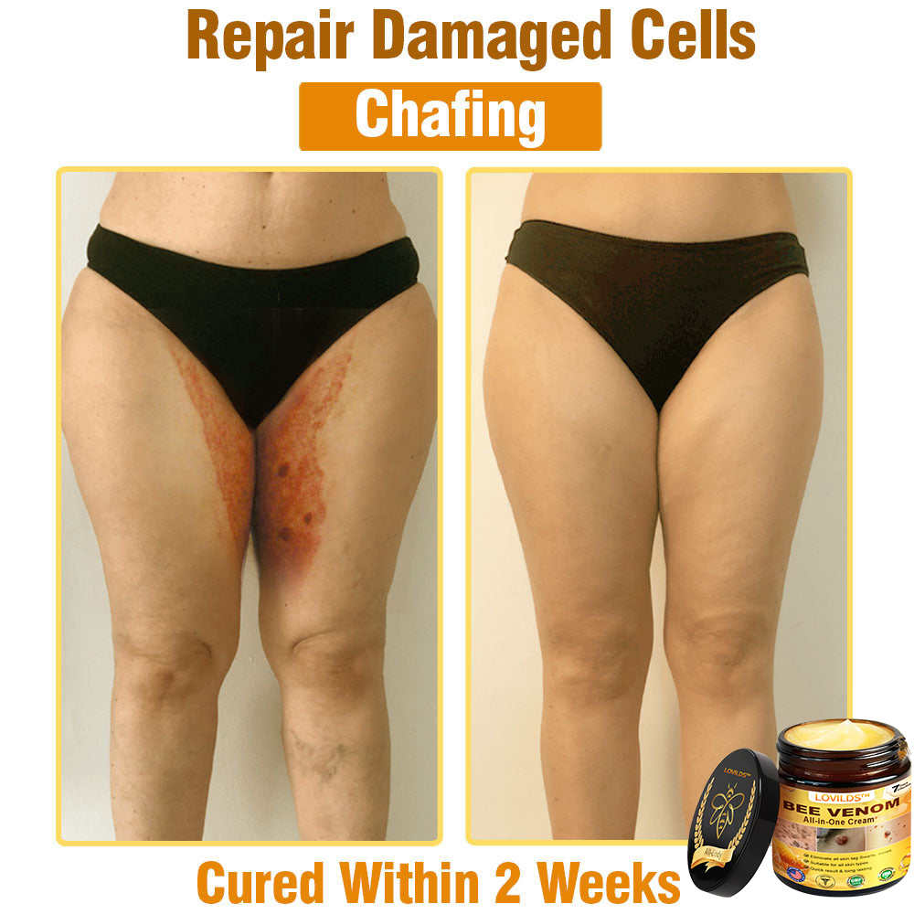 𝐋𝐎𝐕𝐈𝐋𝐃𝐒™ 𝐁𝐞𝐞 𝐕𝐞𝐧𝐨𝐦 𝐀𝐥𝐥-𝐢𝐧-𝐎𝐧𝐞 𝐂𝐫𝐞𝐚𝐦–🌸 🌸Anti-aging,Hydrating, Skin Repair, Even Tone, Acne and Dark Spot Treatment, Wart and Mole Removal, Psoriasis Relief