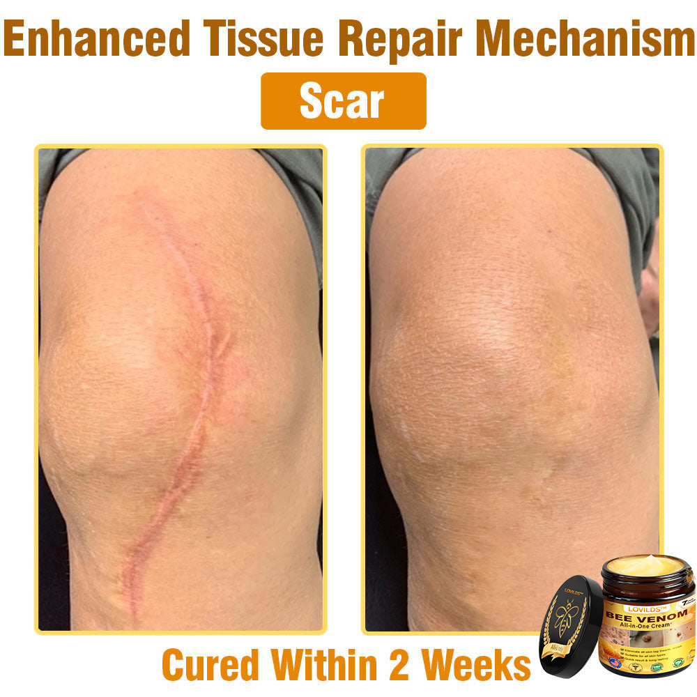 𝐋𝐎𝐕𝐈𝐋𝐃𝐒™ 𝐁𝐞𝐞 𝐕𝐞𝐧𝐨𝐦 𝐀𝐥𝐥-𝐢𝐧-𝐎𝐧𝐞 𝐂𝐫𝐞𝐚𝐦–🌸 🌸Anti-aging,Hydrating, Skin Repair, Even Tone, Acne and Dark Spot Treatment, Wart and Mole Removal, Psoriasis Relief