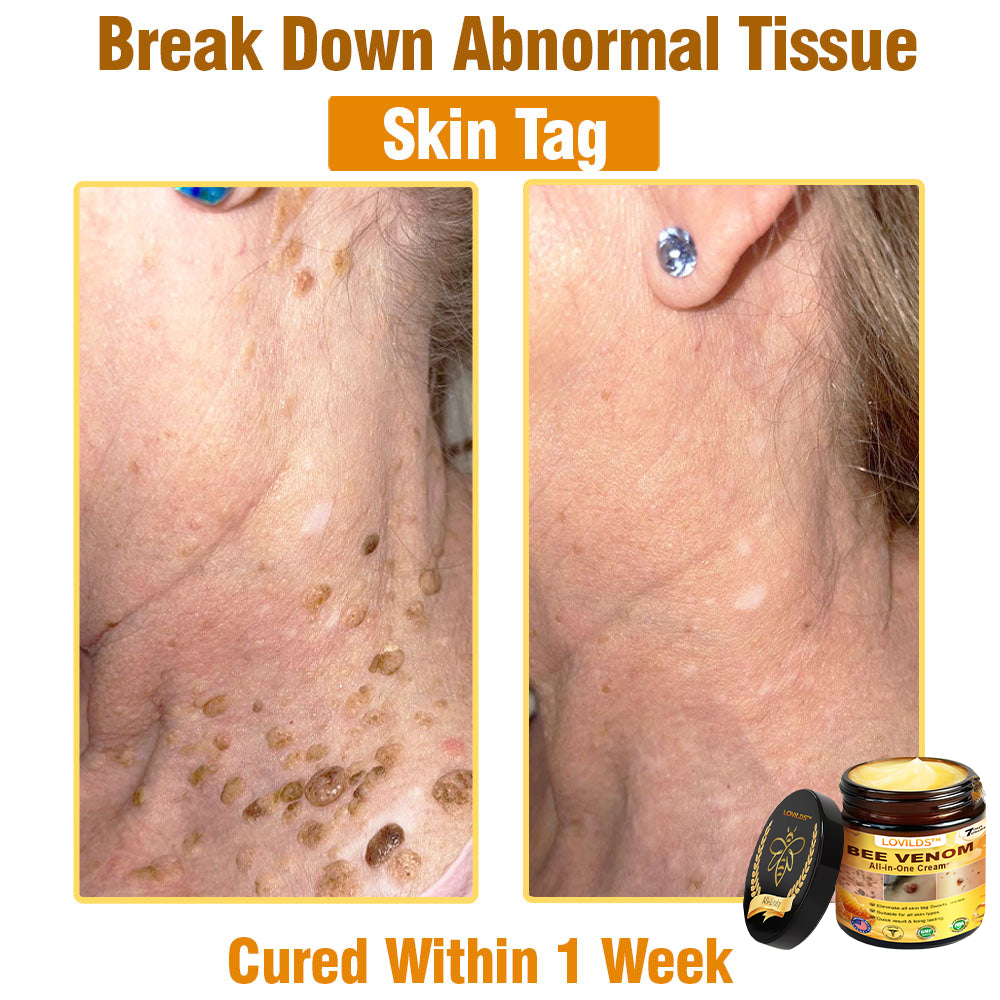 𝐋𝐎𝐕𝐈𝐋𝐃𝐒™ 𝐁𝐞𝐞 𝐕𝐞𝐧𝐨𝐦 𝐀𝐥𝐥-𝐢𝐧-𝐎𝐧𝐞 𝐂𝐫𝐞𝐚𝐦–🌸 🌸Anti-aging,Hydrating, Skin Repair, Even Tone, Acne and Dark Spot Treatment, Wart and Mole Removal, Psoriasis Relief