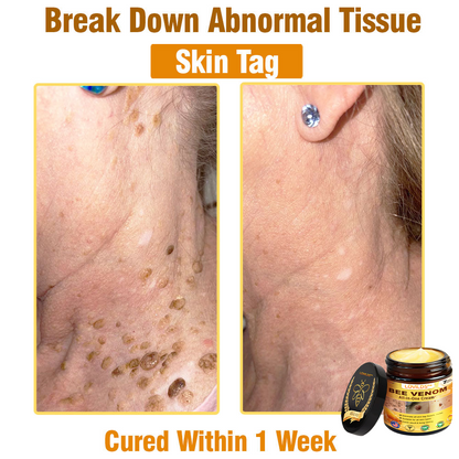 𝐋𝐎𝐕𝐈𝐋𝐃𝐒™ 𝐁𝐞𝐞 𝐕𝐞𝐧𝐨𝐦 𝐀𝐥𝐥-𝐢𝐧-𝐎𝐧𝐞 𝐂𝐫𝐞𝐚𝐦–🌸 🌸Anti-aging,Hydrating, Skin Repair, Even Tone, Acne and Dark Spot Treatment, Wart and Mole Removal, Psoriasis Relief