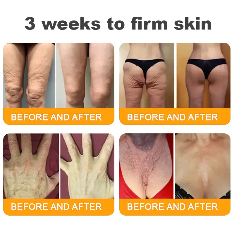 𝐋𝐎𝐕𝐈𝐋𝐃𝐒™ 𝐁𝐞𝐞 𝐕𝐞𝐧𝐨𝐦 𝐀𝐥𝐥-𝐢𝐧-𝐎𝐧𝐞 𝐂𝐫𝐞𝐚𝐦–🌸 🌸Anti-aging,Hydrating, Skin Repair, Even Tone, Acne and Dark Spot Treatment, Wart and Mole Removal, Psoriasis Relief